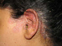 Side effects of long term topical steroids