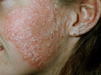 Topical steroid side effects rash